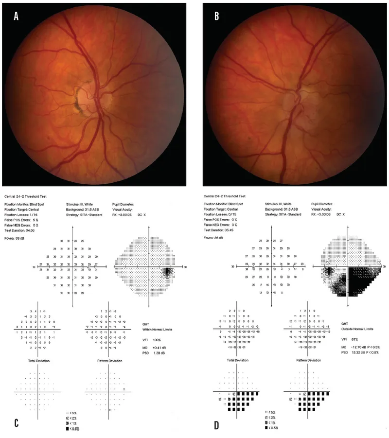 NAION optic disc edema and visual field defect
