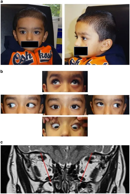 CN III palsy with eye deviation and MRI