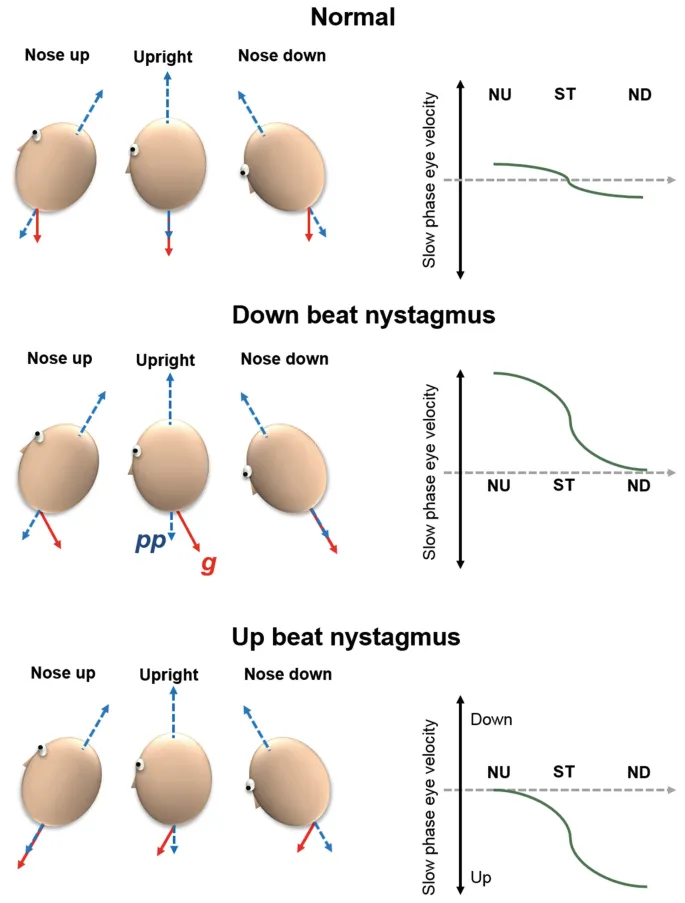 Downbeat and Upbeat Nystagmus Eye Velocity vs Head Position