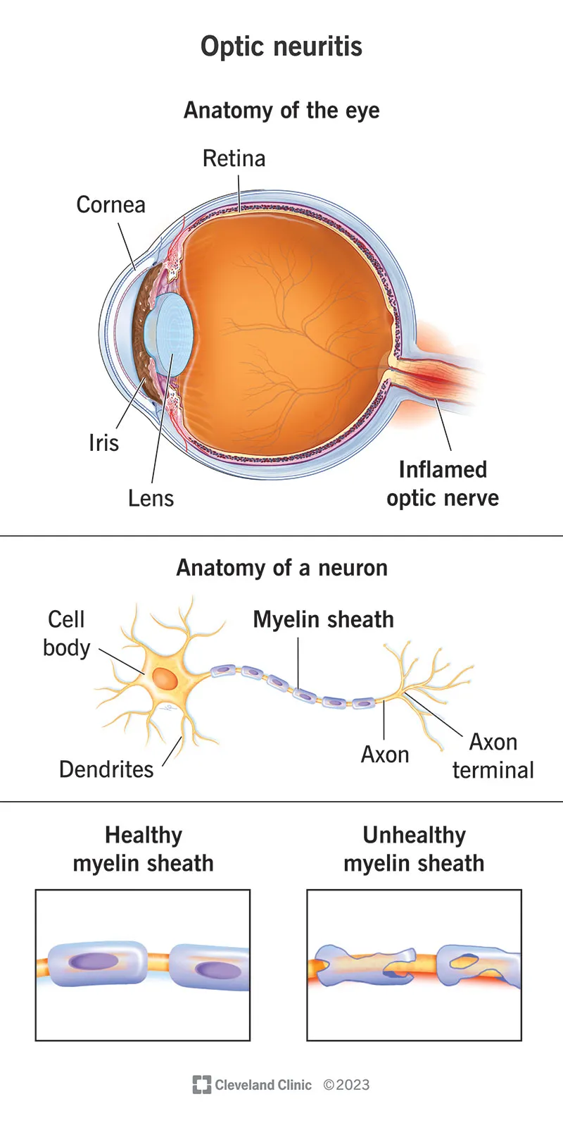 Optic neuritis: eye anatomy, neuron, myelin sheath