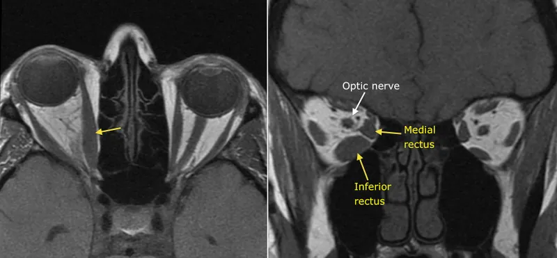MRI: Enlarged extraocular muscles, optic nerve