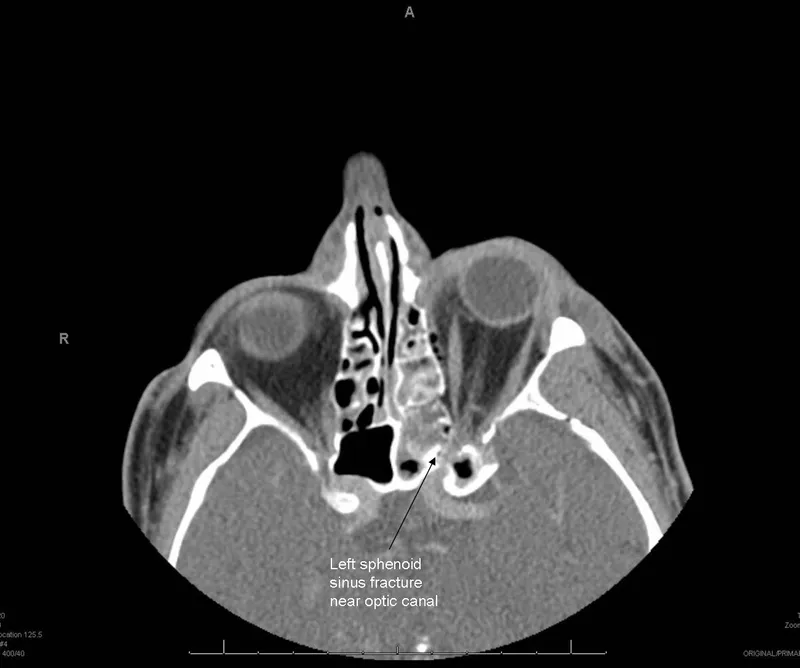 Axial CT: Left sphenoid sinus fracture near optic canal