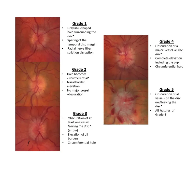 Frisen Papilledema Grading Scale