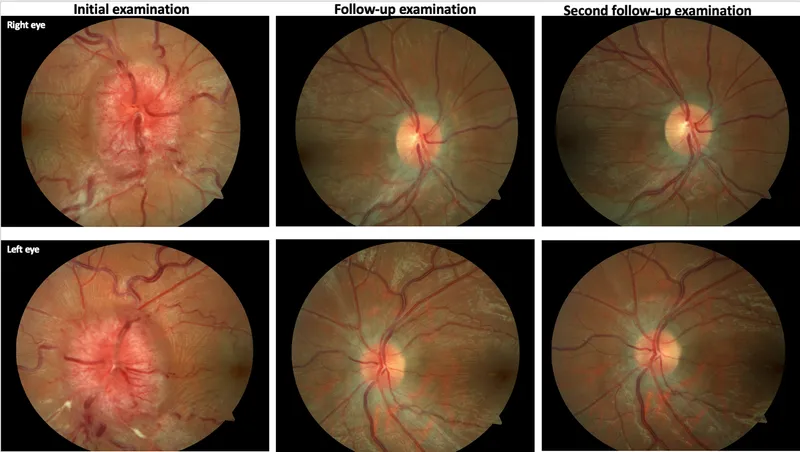 Papilledema resolution over time