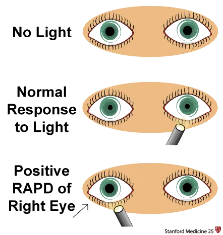 Swinging flashlight test for RAPD diagram