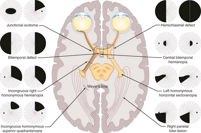 Visual field defects and lesion locations