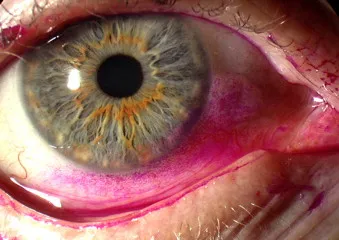 Rose Bengal staining in Keratoconjunctivitis Sicca