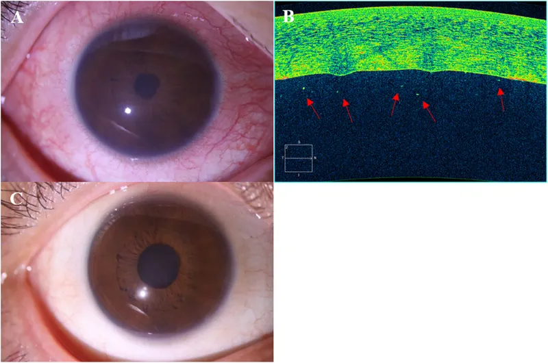 Clinical signs of acute anterior uveitis