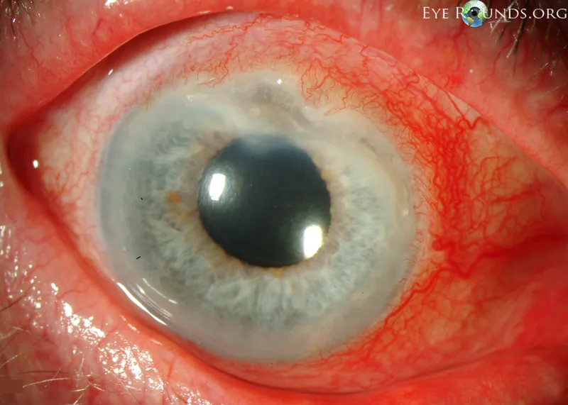 Necrotizing scleritis and peripheral ulcerative keratitis