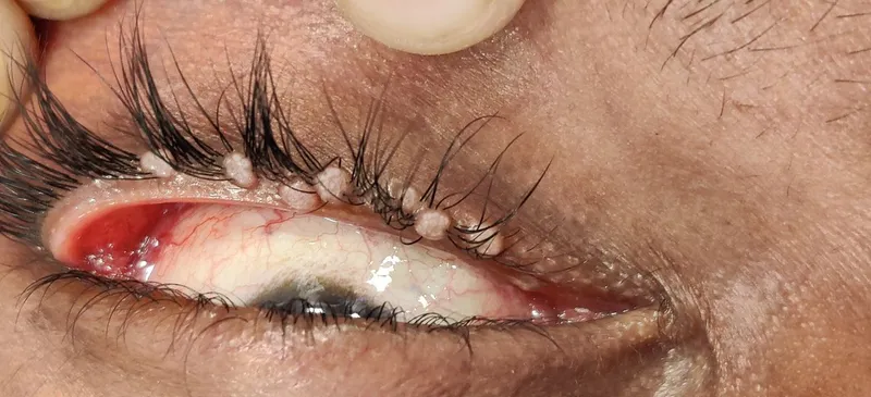 Molluscum contagiosum lesions on eyelid margin in HIV