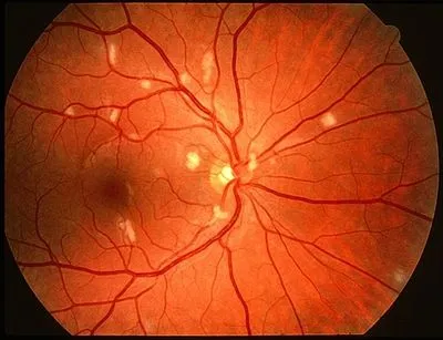HIV Retinopathy with Cotton Wool Spots and Hemorrhages