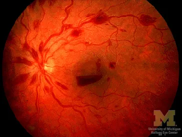 Retinal hemorrhages in thrombocytopenia