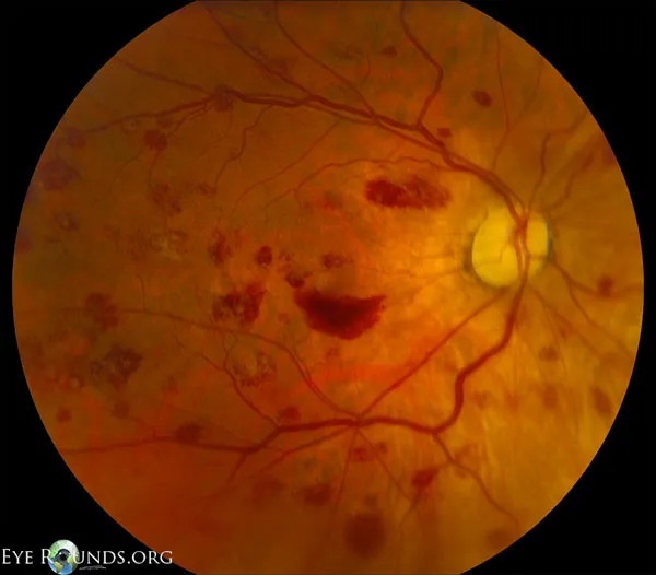 Leukemic retinopathy with Roth spots