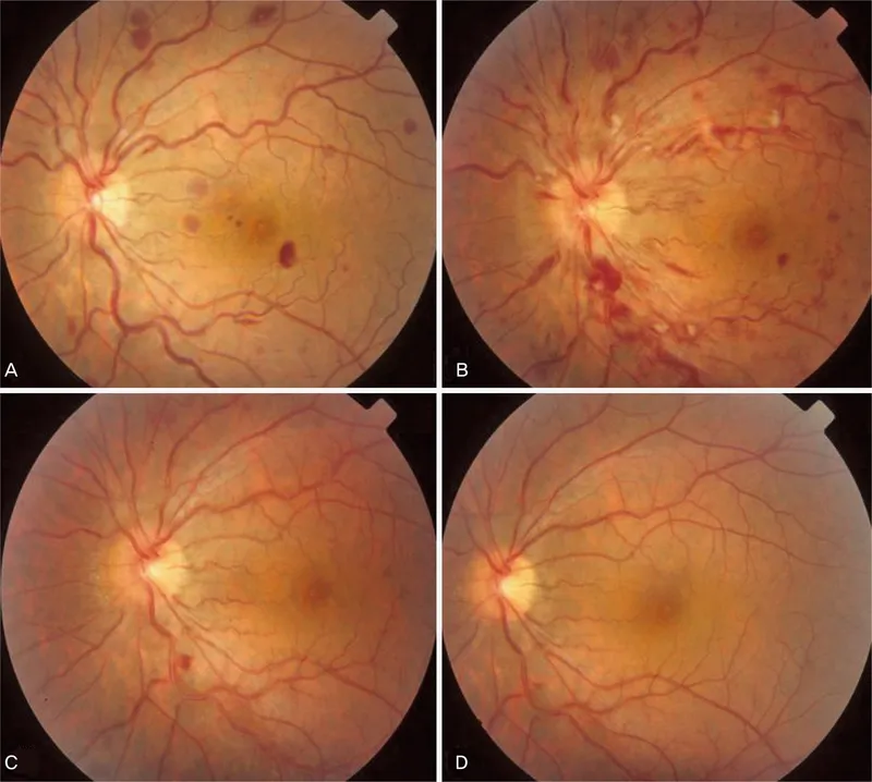 Fundus: Retinal venous tortuosity and hemorrhages