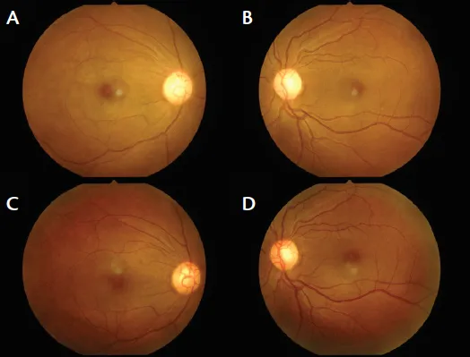 Fundus findings in severe anemia