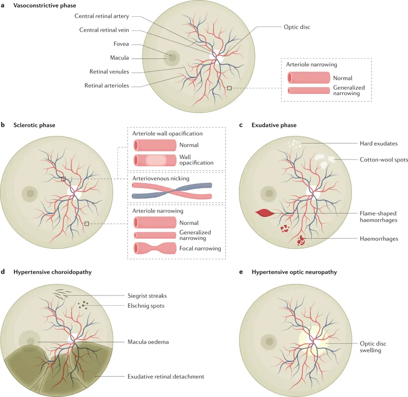 Hypertensive Retinopathy Phases