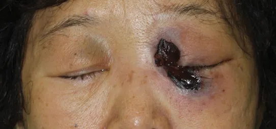 Rhino-orbital mucormycosis with black eschar