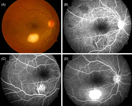 Choroidal tubercle in ocular TB