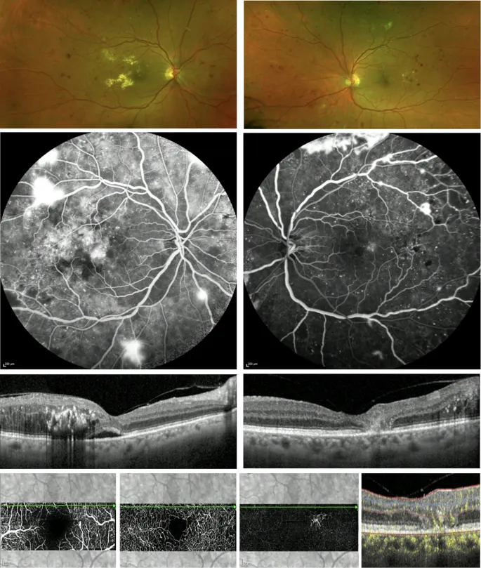 Diabetic Retinopathy: Fundus, Angiography, and OCT