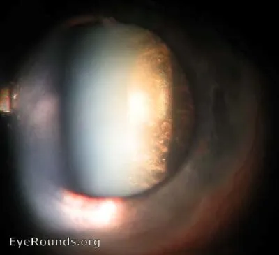 Posterior subcapsular cataract