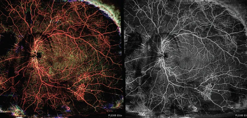OCT Angiography of Proliferative Diabetic Retinopathy