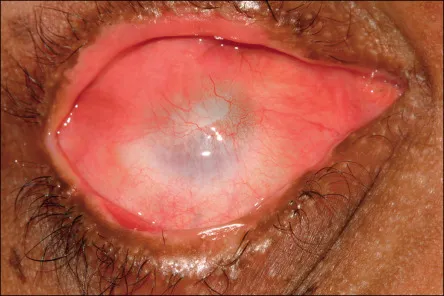 Severe chemical burn to the eye