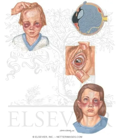 Ocular Manifestations of Child Abuse