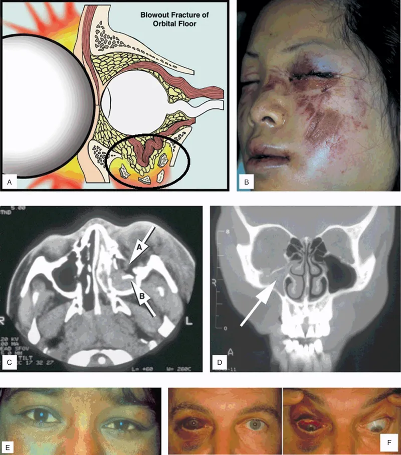 Blowout fracture of orbital floor