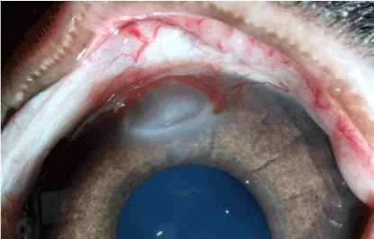 Corneal opacity from thermal burn