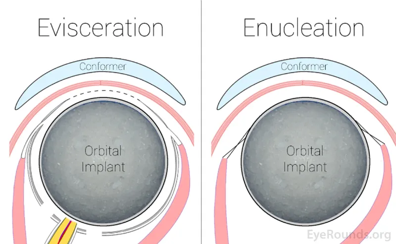 Evisceration vs. Enucleation for Anophthalmic Socket