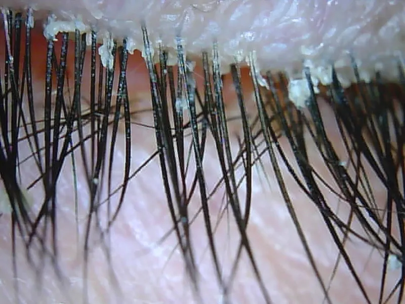 Anterior blepharitis with collarettes and scales