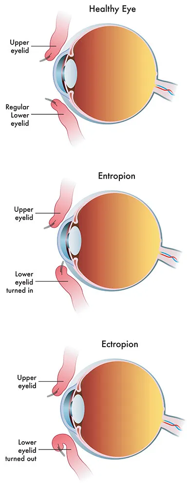 Healthy eye, entropion, and ectropion diagram