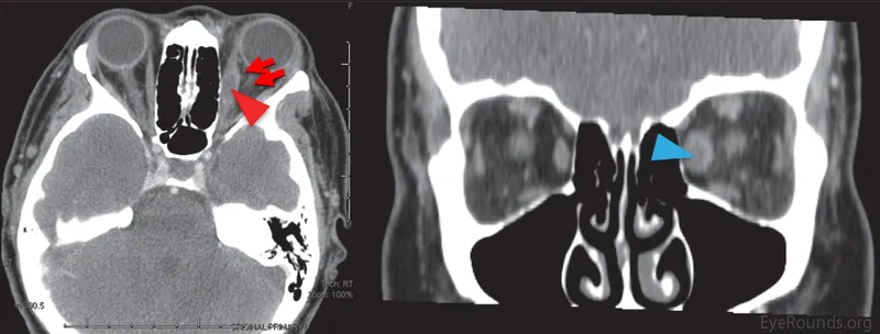 Axial and coronal CT showing orbital myositis