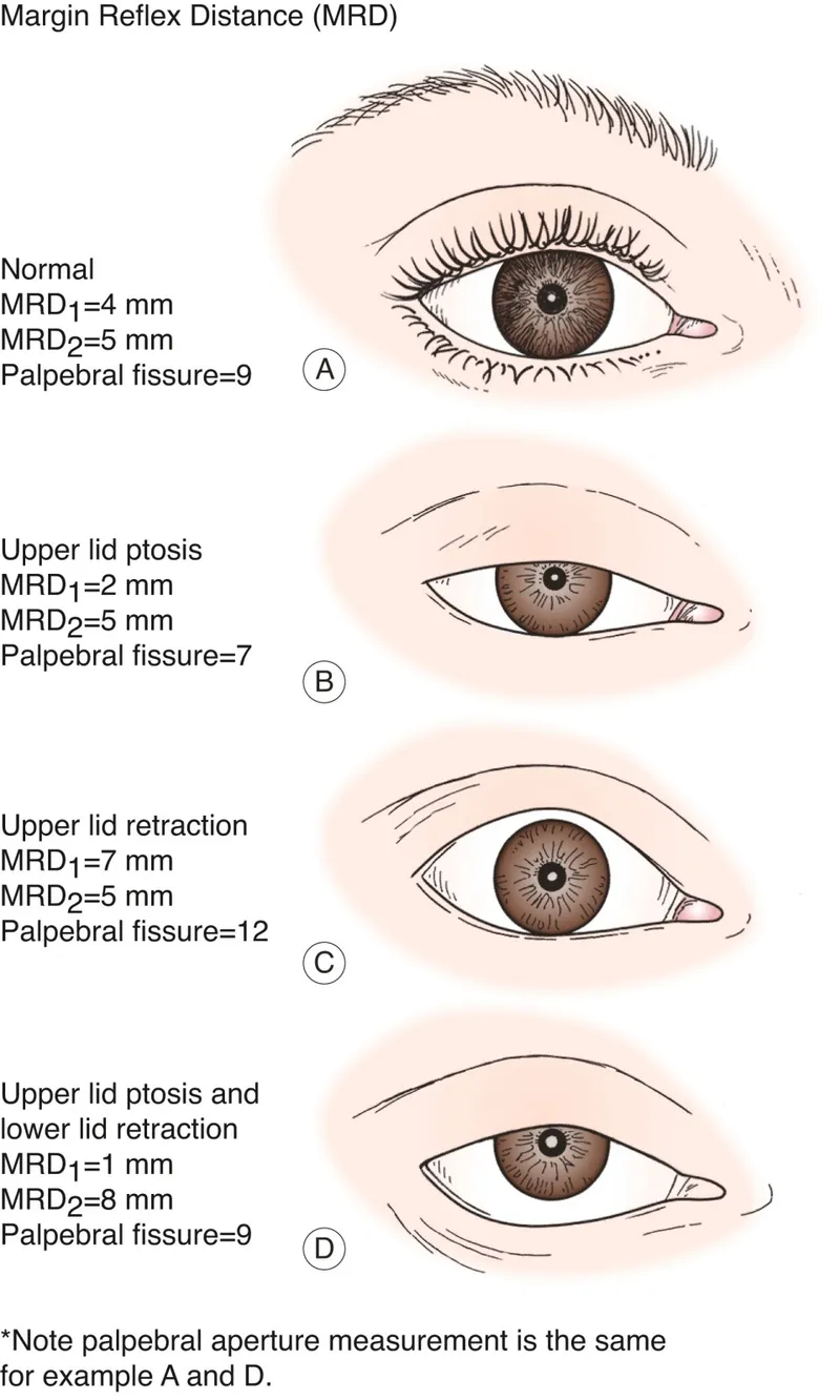 MRD and Palpebral Fissure Measurement in Ptosis