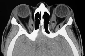 Axial CT orbits: Thyroid eye disease with muscle enlargement
