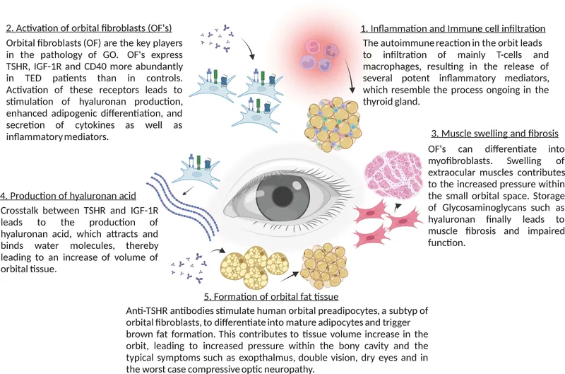 Thyroid Eye Disease Pathophysiology