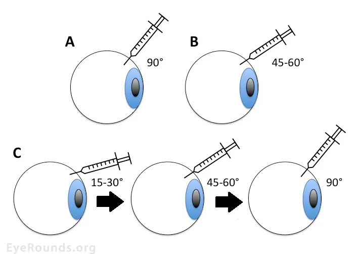 Intravitreal injection needle angles