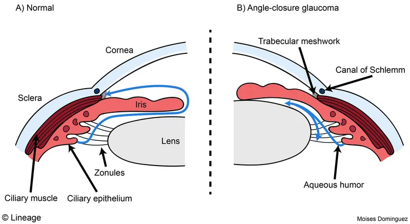 Normal vs Angle-Closure Glaucoma Eye Anatomy