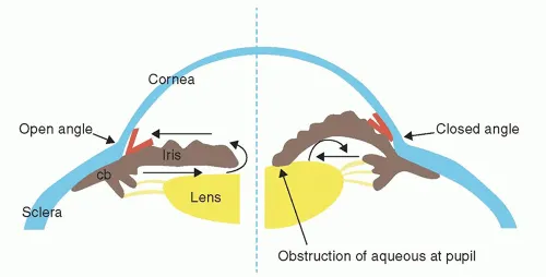 Open vs Closed Anterior Chamber Angle Diagram