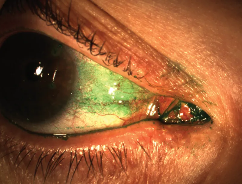 Fluorescein staining of corneal abrasion