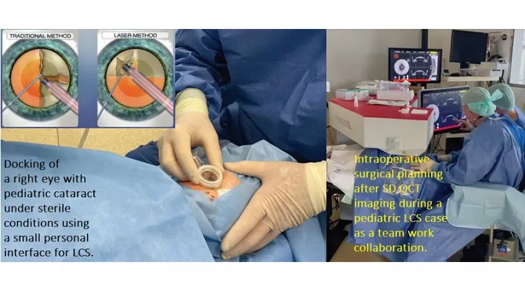 Femtosecond Laser Cataract Surgery Interface and Planning