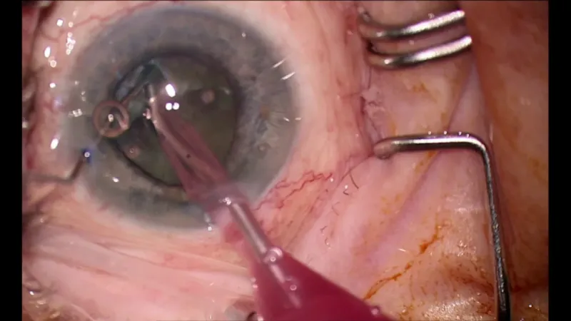 Phacoemulsification during cataract surgery