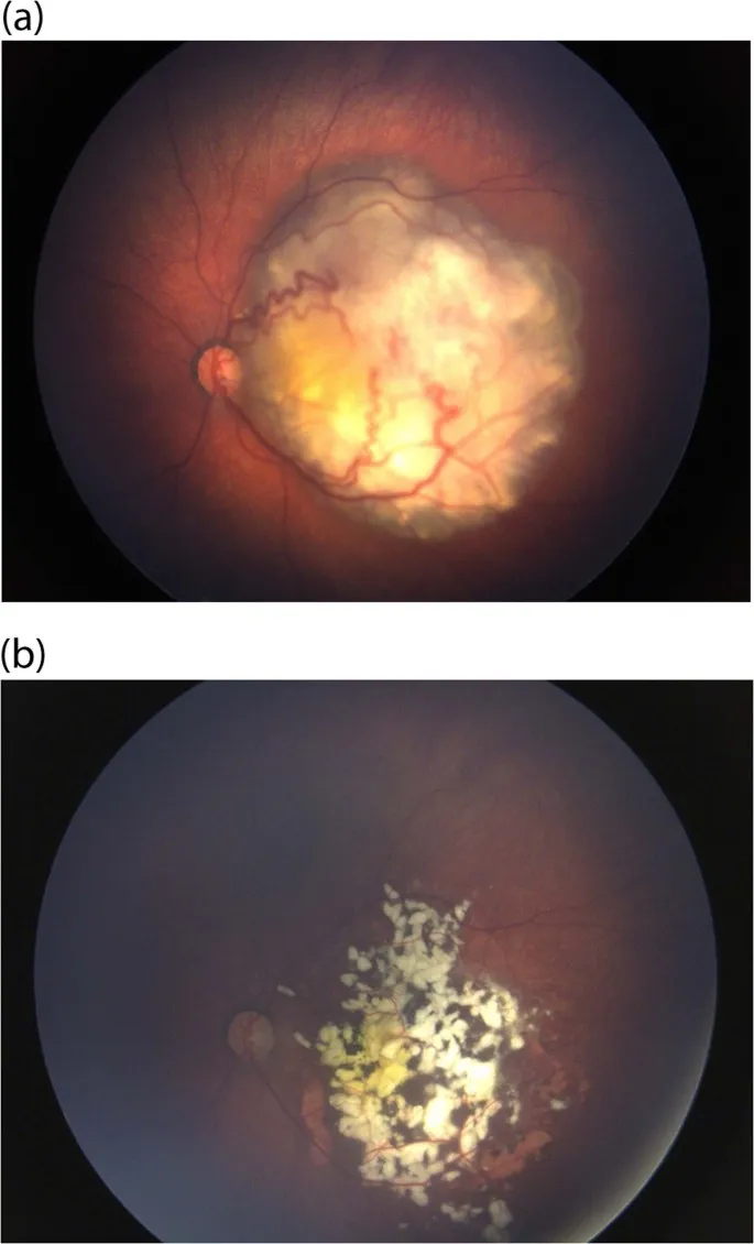 Retinoblastoma with calcification and vitreous seeds