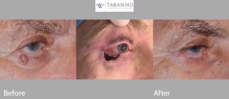 Eyelid BCC excision and reconstruction