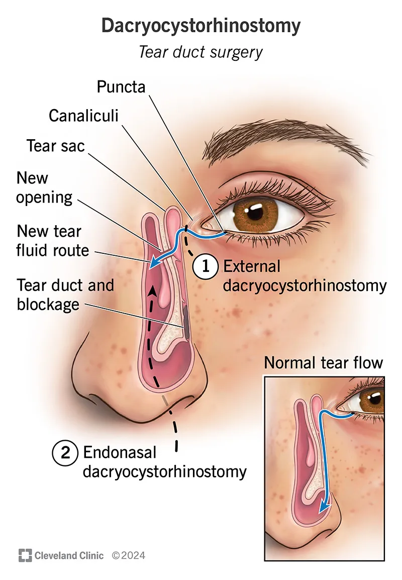 Dacryocystorhinostomy (DCR) tear duct surgery
