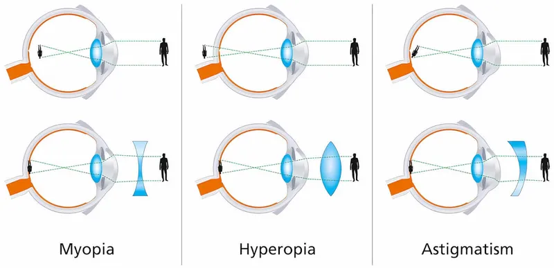 Light focus in myopia, hyperopia, and astigmatism