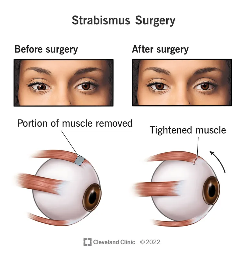 Strabismus Surgery: Before and After