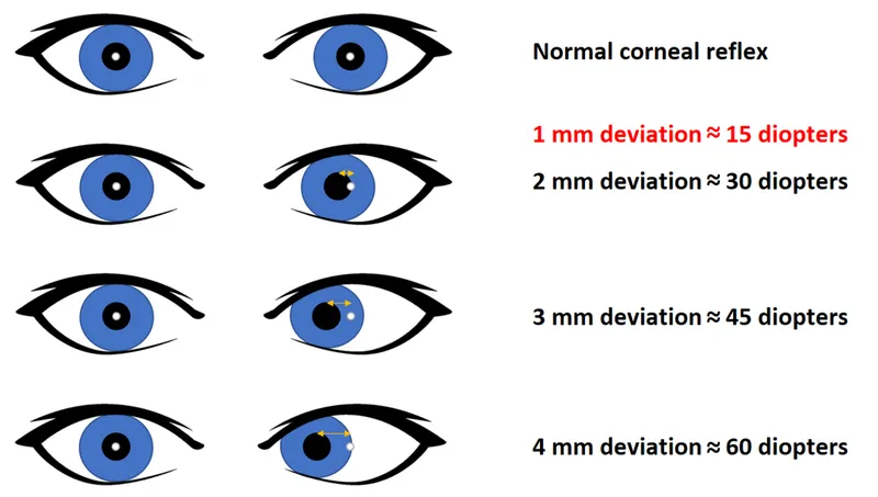 Hirschberg test corneal light reflex deviation and diopters