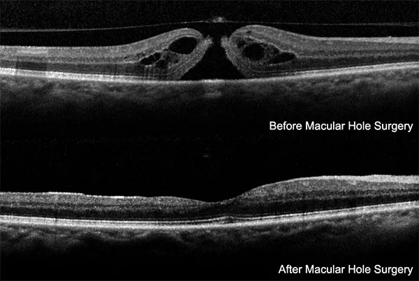 OCT Macular Hole Before and After Surgery