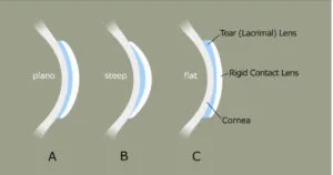 Tear lens formation with rigid contact lens on cornea
